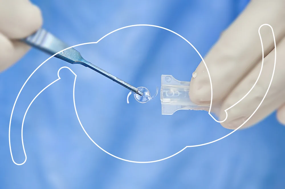 Chirurgie de la cataracte Annecy 74 - Dr Guignier